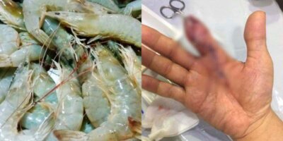 Hilang Jari Kerana Tercucuk Udang Ketika Menyiang Udang