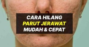 hilangkan parut jerawat