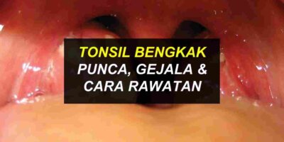Tonsil Bengkak : Punca, Simptom & Cara Rawat