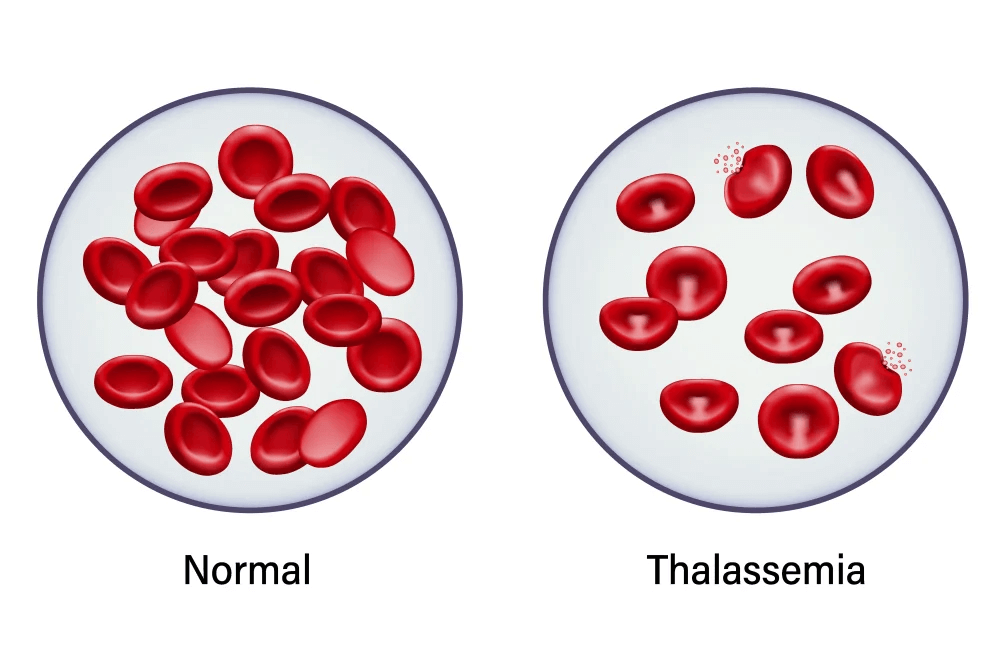 talasemia maksud